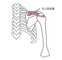 岡上肌肌腱炎