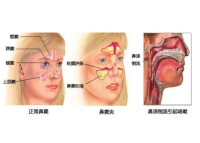 黴菌性鼻竇炎