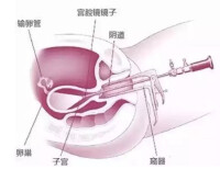 宮腔鏡檢查術