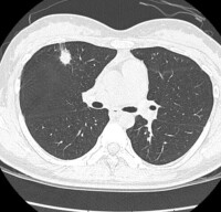 肺纖維灶CT