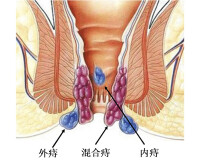 肛乳頭增生