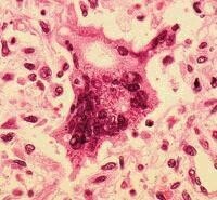 麻疹多核巨細胞2