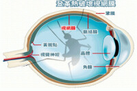 糖尿病性視網膜病