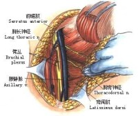 臂叢神經痛