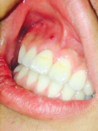 牙齒腫痛