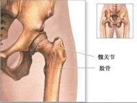 髖關節后脫位