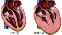 原發性心肌病