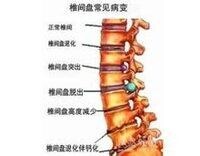 椎間盤常見病變說明圖