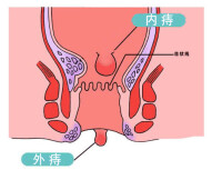 混合痔切除術