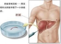 肝穿刺活檢