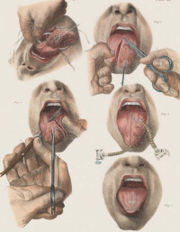 舌癌手術
