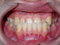 牙齦