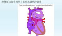 部分型肺靜脈異位引流