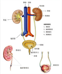 人體泌尿,膽繫結石