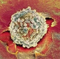 顯微鏡下的癌細胞