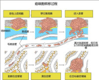 腫瘤轉移