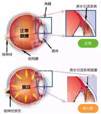 慢性青光眼