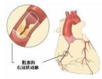 心臟支架