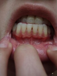牙床萎縮