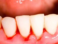 牙床萎縮