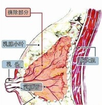 BRCA1 直接與遺傳性乳腺癌有關