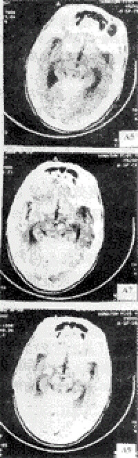 人腦CT(示四疊體)