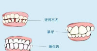 牙列不齊