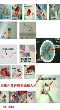 （圖）放射生物學臨床表現
