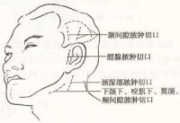 圖4，口腔頜面部間隙膿腫常用切口