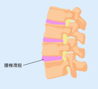 椎體滑脫