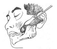 口腔頜面部手術治療
