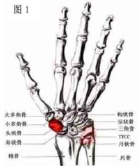 月狀骨骨軟骨病