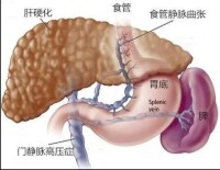 圖4 門脈高壓症