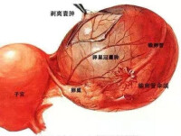 卵巢多發性囊腫