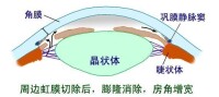 閉角型青光眼