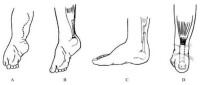 跟腱攣縮臨床表現