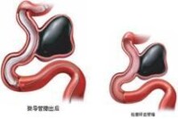 腦血管栓塞