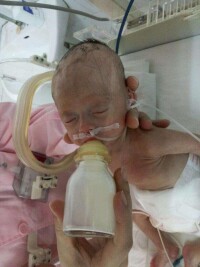 早產兒因氧中毒失明