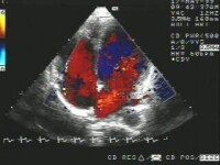 彩色多普勒超聲心動圖