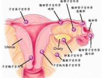 宮外孕流產