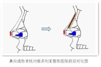 鼻尖整形術