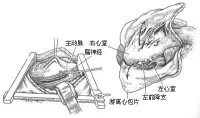 心包剝脫術