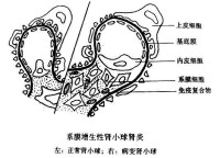 系膜毛細血管性腎小球腎炎