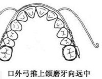 牙列不齊